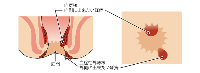 いぼ痔（内痔核と血栓性外痔核）の肛門断面図