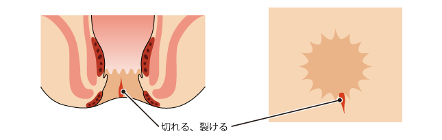裂肛（切れ痔）の肛門断面図